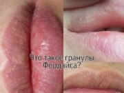 Что называется гранулами Фордайса: лечится ли это?