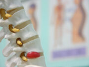 Лечение межпозвоночной грыжи: с чего стоит начать и куда обратиться?