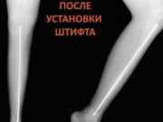 Врачам удалось укрепить кости ребенка с редким заболеванием