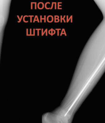 Врачам удалось укрепить кости ребенка с редким заболеванием